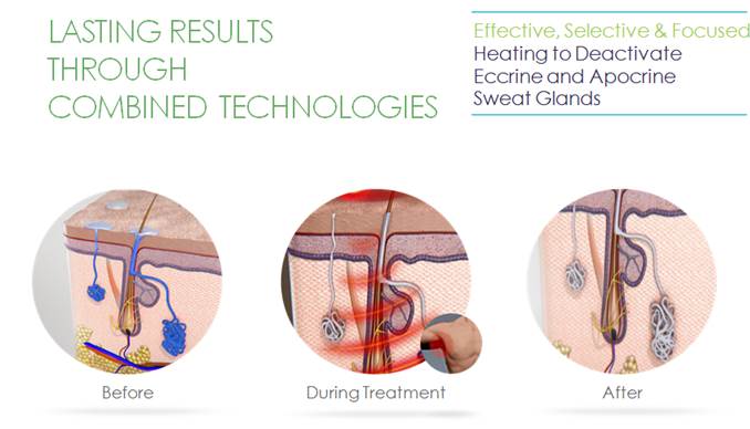 電波技術如何治療多汗症？